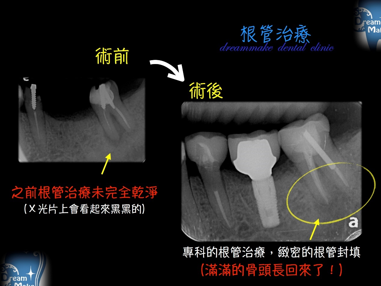 根管治療